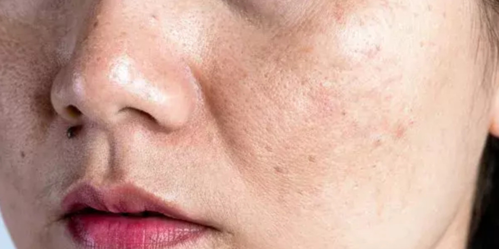 Hyper Pigmentation Treatment