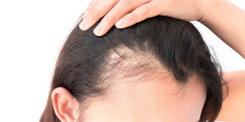 Hair Loss Treatment