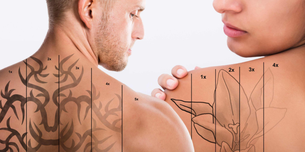 Tattoo Removal