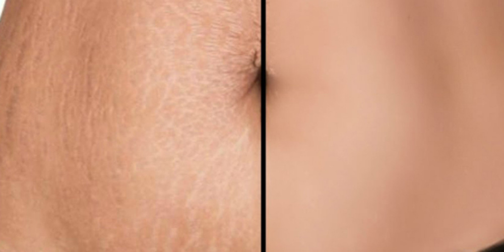 Stretch Marks Treatment