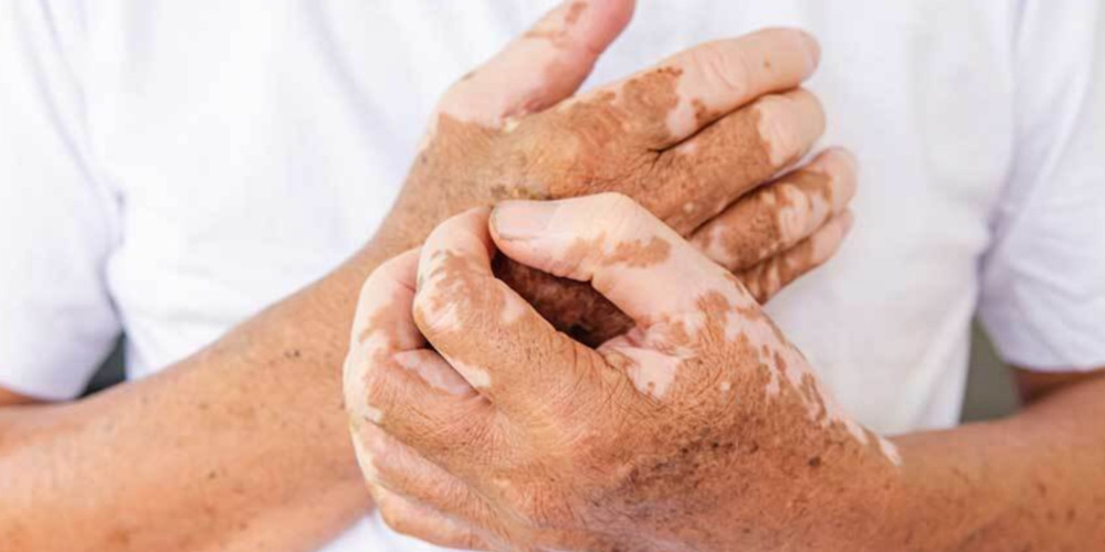Medical Vitiligo Treatment