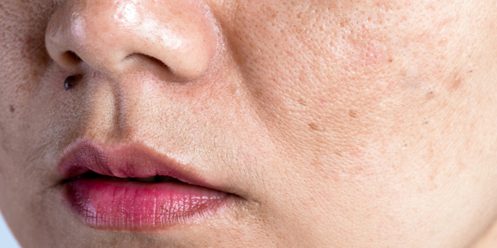 Pigmentation Treatment