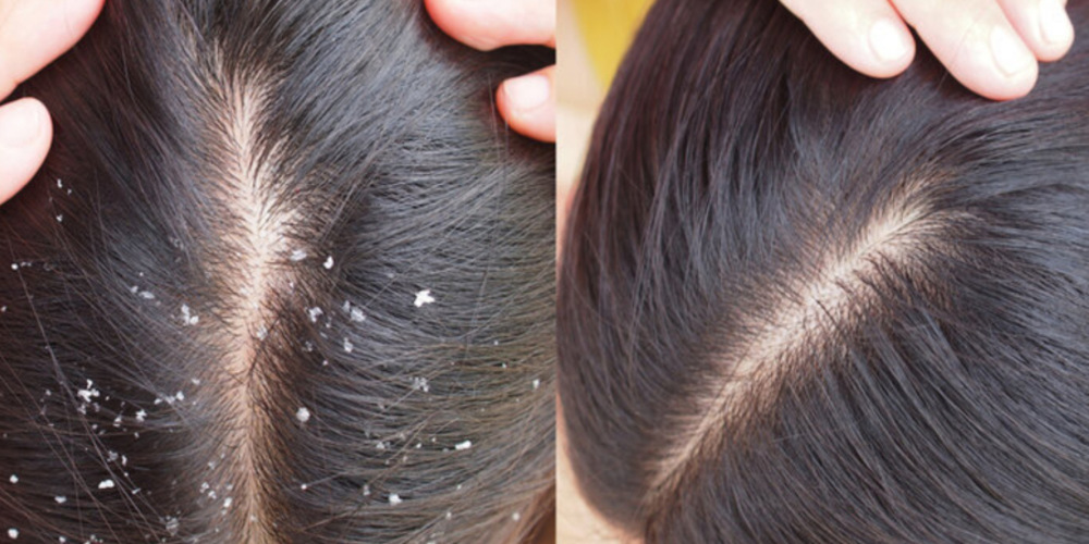 Dandruff Treatment
