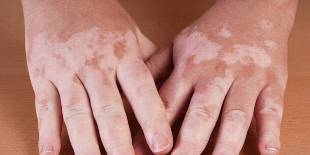 Leucoderma Treatment