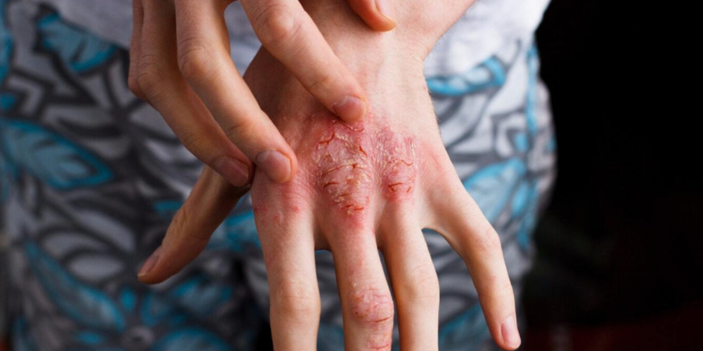 Atopic Dermatitis Treatment