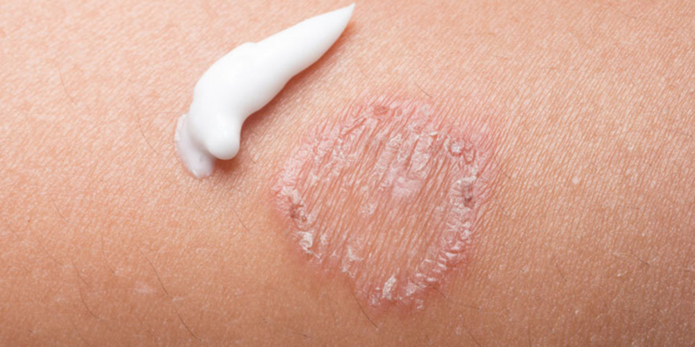 Treatment For Ringworm