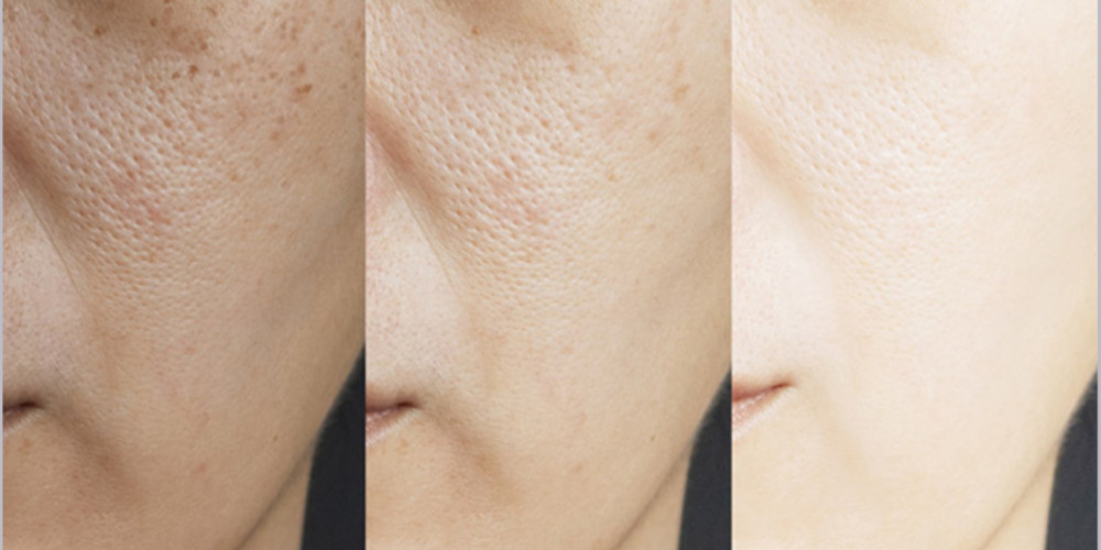 Glutathione – Skin Whitening
