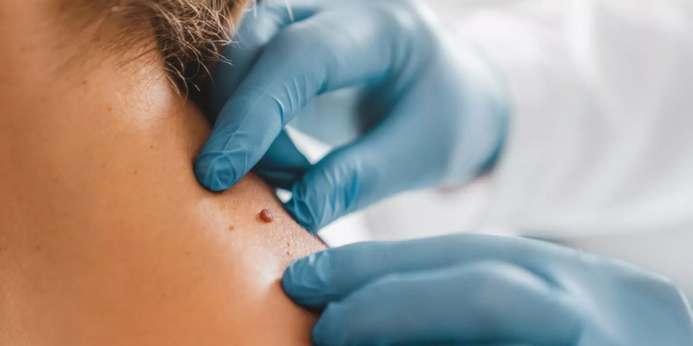 Skin Tag Surgical Removal