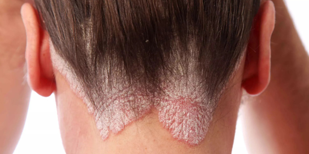 Psoriasis Treatment