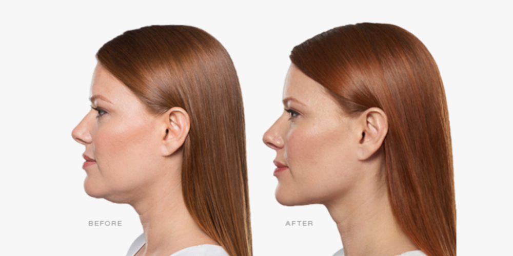 Double Chin Treatment