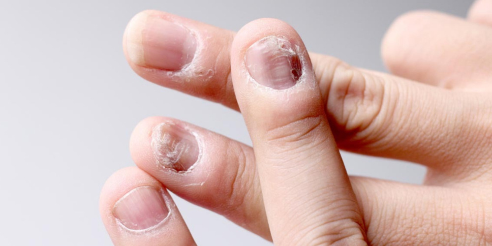 Nail Diseases Treatment