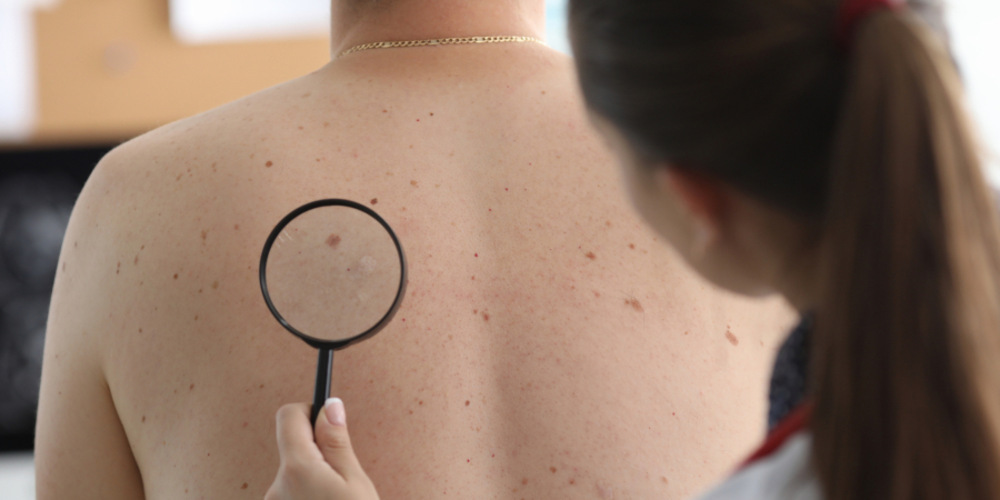 Sun Spots, Age Spots and Other Pigmented Lesions