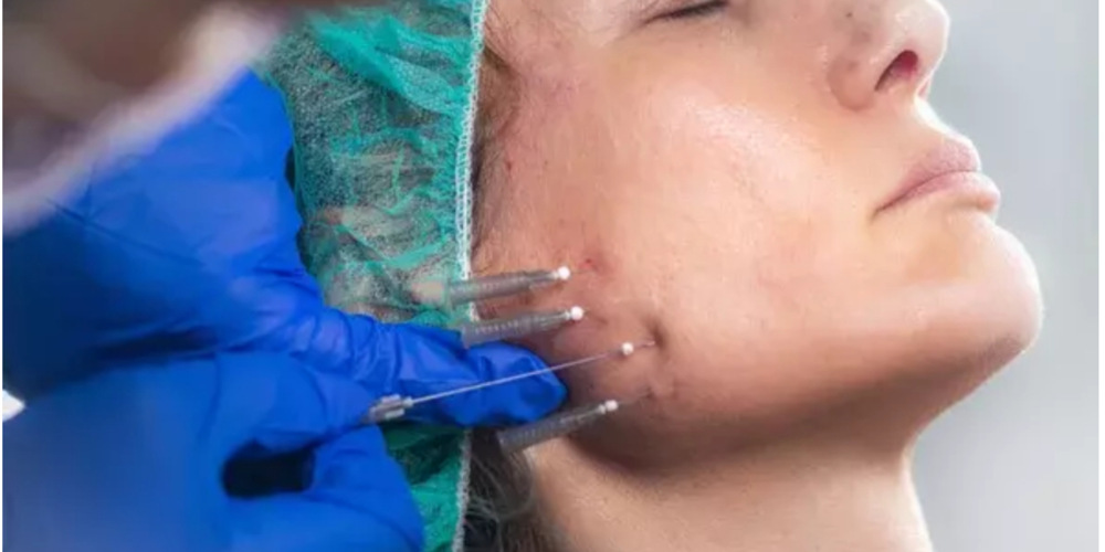 Thread Lift