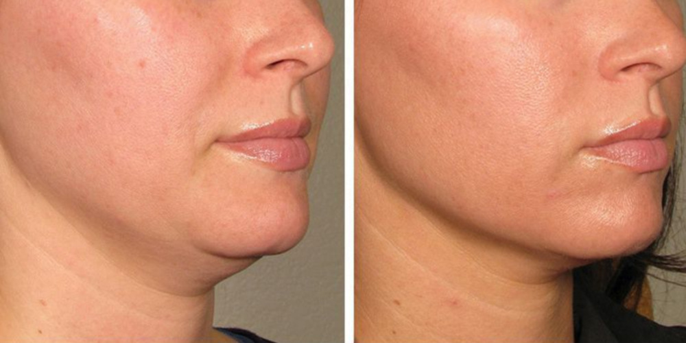Skin Tightening