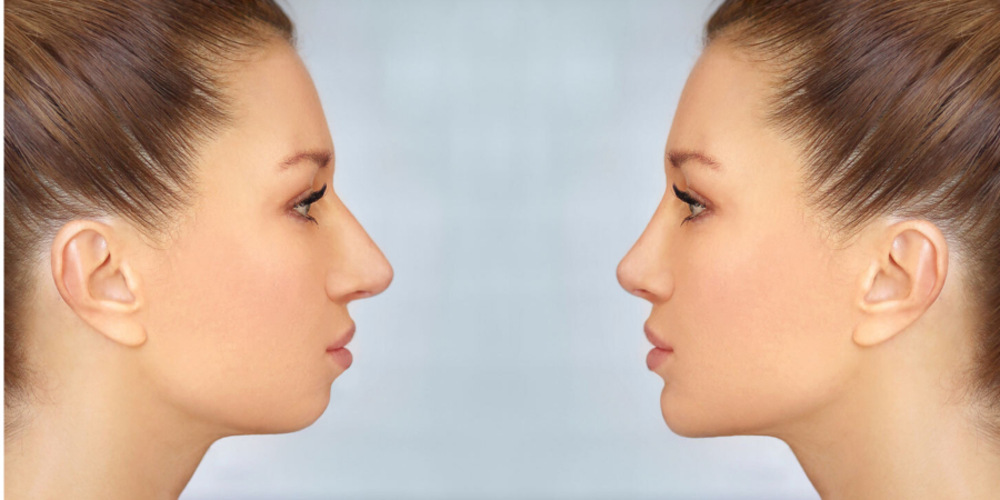 Chin Augumentation (Mentoplasty)