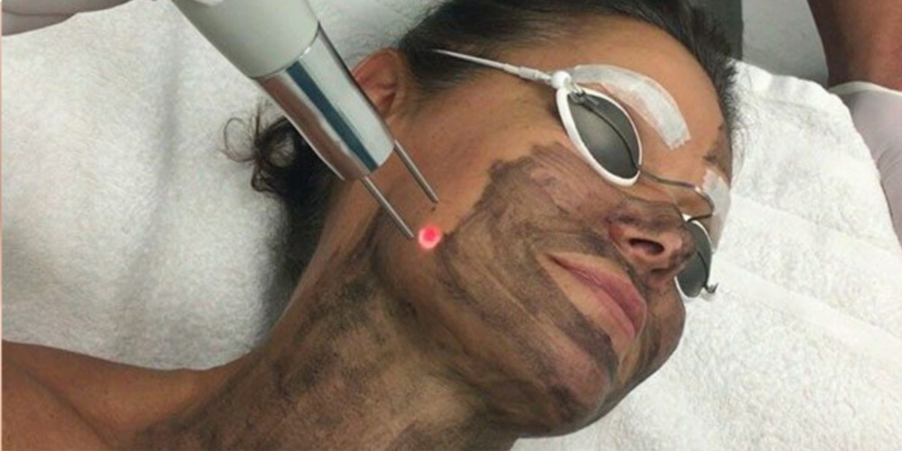 Carbon Peel