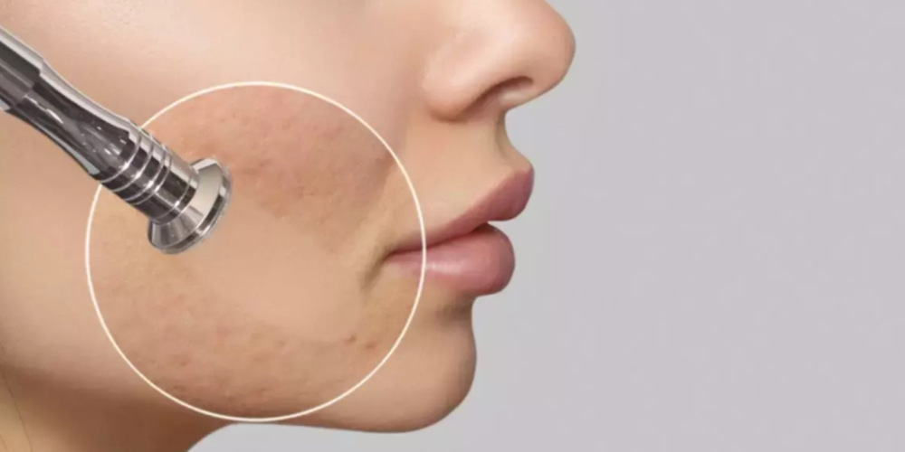 Skin Polishing