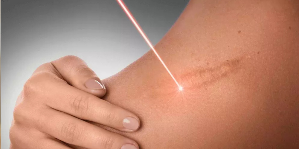 Scar Reduction