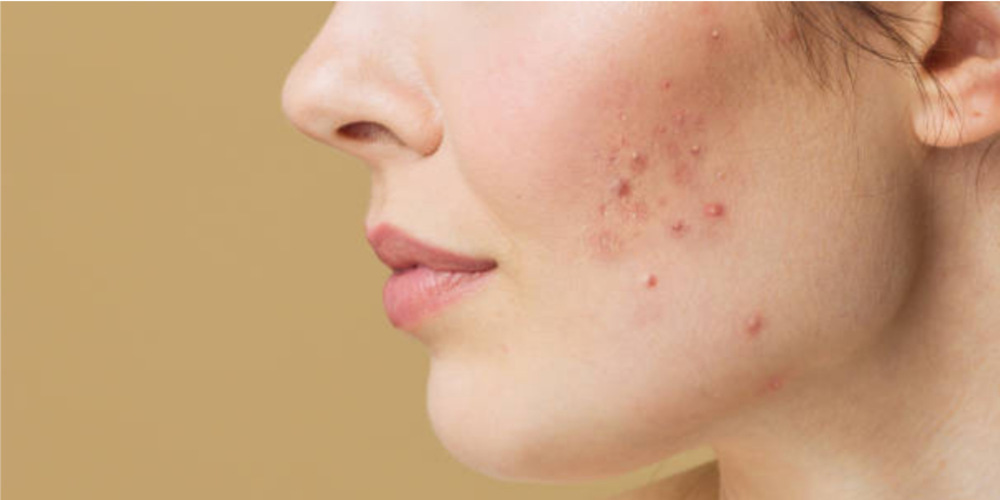 Acne/ Pimples Treatment