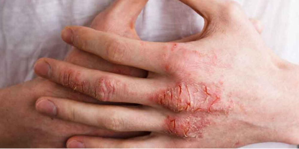 Eczema Treatment
