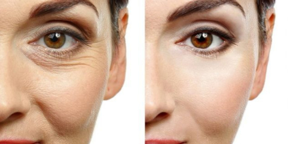 Wrinkle Treatment