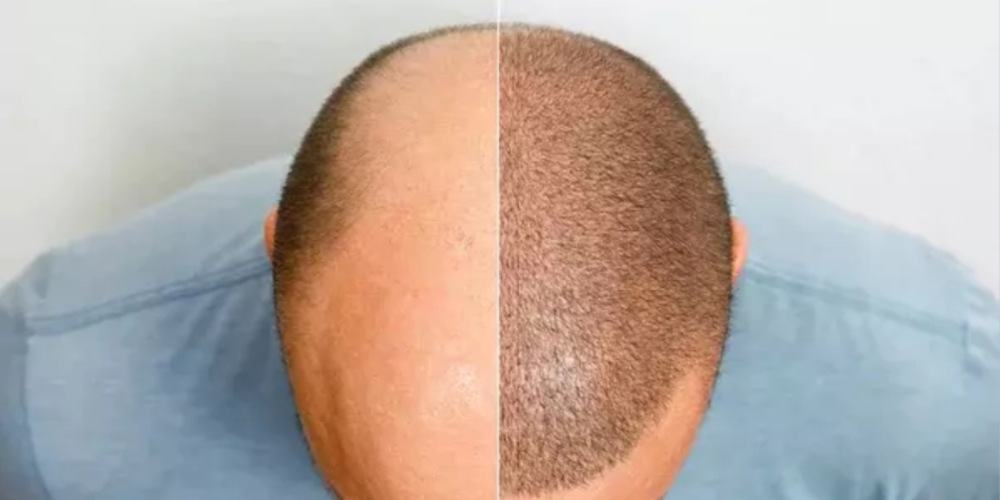 Hair Transplant Surgery