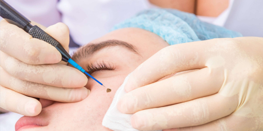 Mole Removal