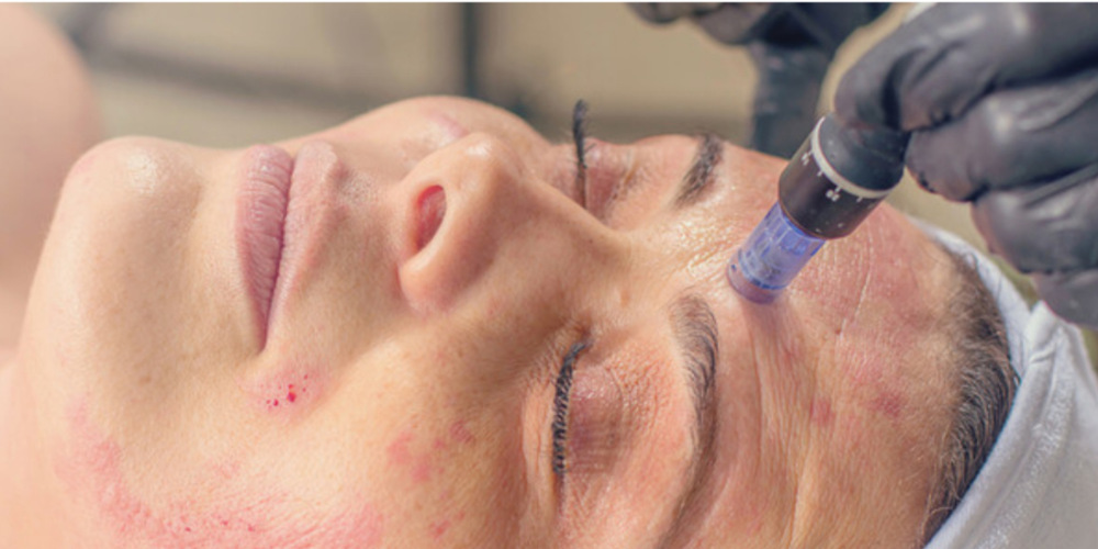 Vampire Facial