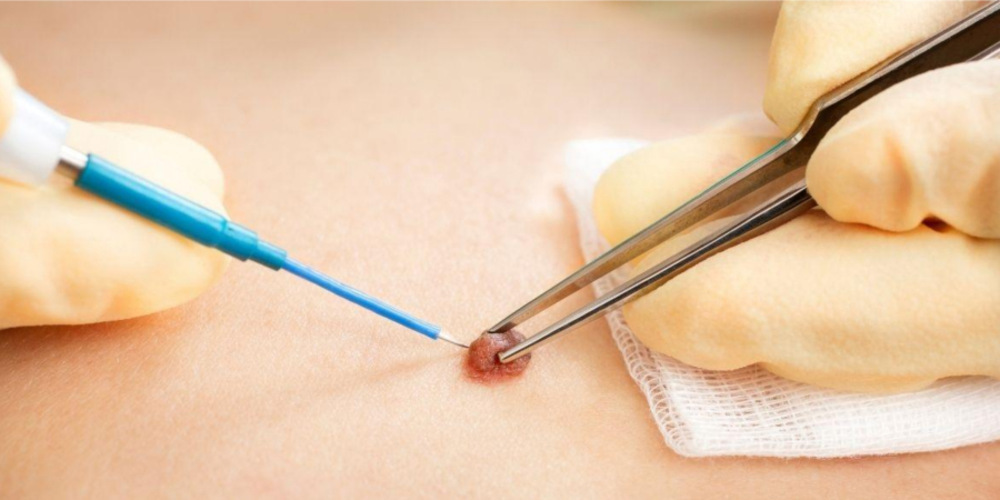 Wart Removal